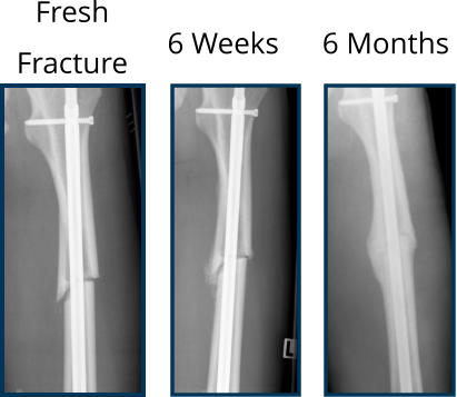 Ultrasound Bone Stimulator Accelerates Clinical and Radiographic