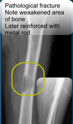 Pathological fracture Note weaakened area  of bone  Later reinforced with  metal rod