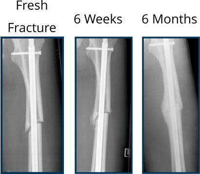 Fresh  Fracture 6 Weeks 6 Months